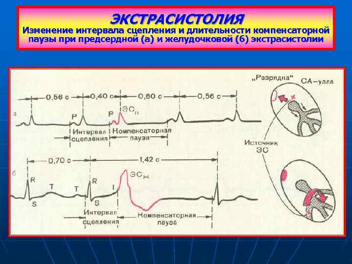 Желудочковая эктопическая активность в виде одиночных экстрасистол