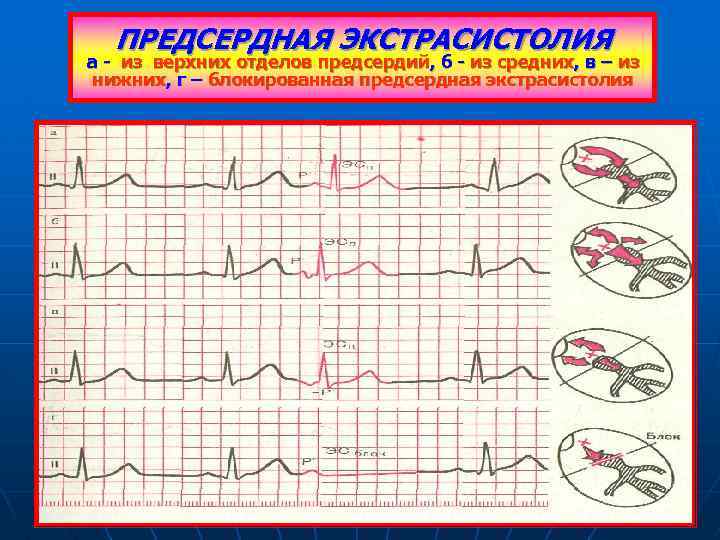 ПРЕДСЕРДНАЯ ЭКСТРАСИСТОЛИЯ а - из верхних отделов предсердий, б - из средних, в –