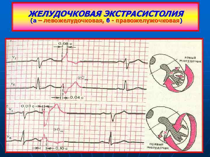 Желудочковая экс. Левожелудочковые экстрасистолы на ЭКГ. Правая желудочковая экстрасистолия. Желудочковая экстрасистолия на ЭКГ. Желудочковая экстрасистолия левожелудочковая.