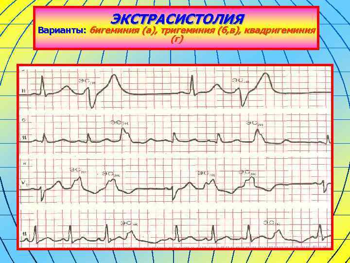 ЭКСТРАСИСТОЛИЯ Варианты: бигеминия (а), тригеминия (б, в), квадригеминия (г) 