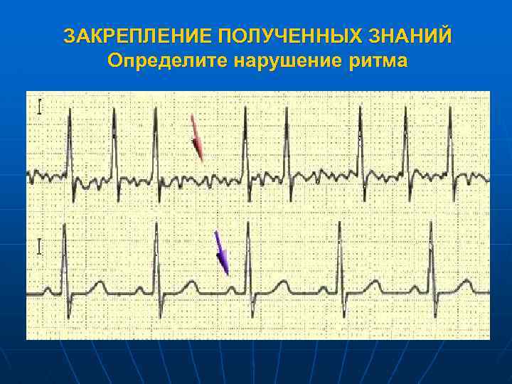 ЗАКРЕПЛЕНИЕ ПОЛУЧЕННЫХ ЗНАНИЙ Определите нарушение ритма 
