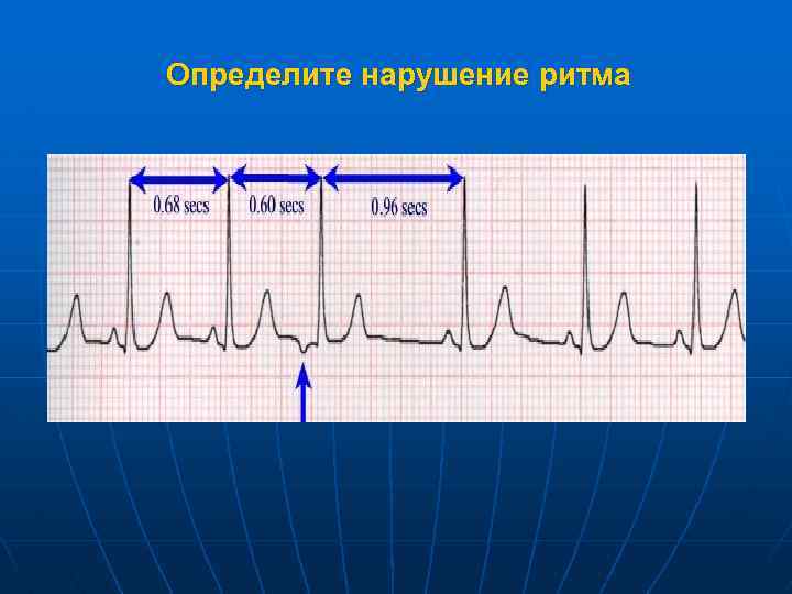 Определите нарушение ритма 