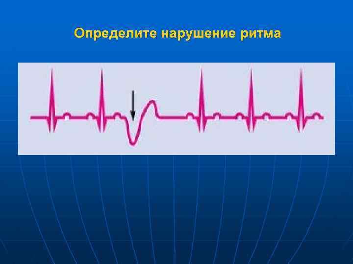 Определите нарушение ритма 
