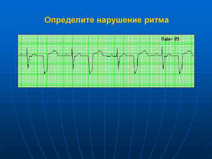 Определите нарушение ритма 