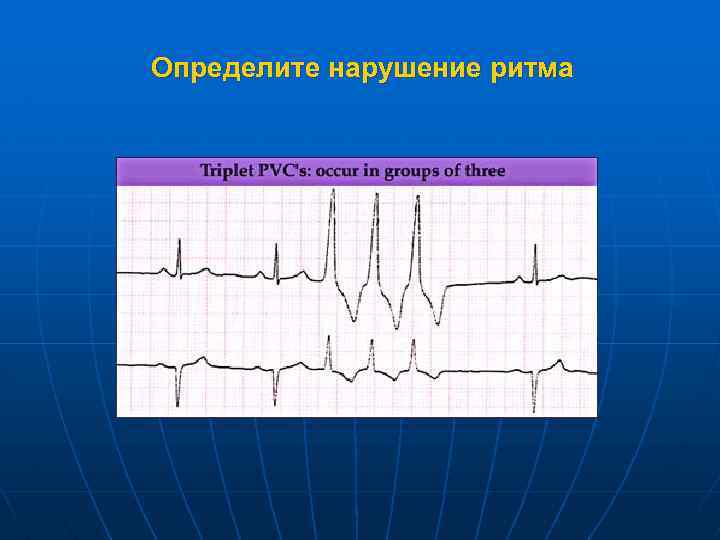 Определите нарушение ритма 