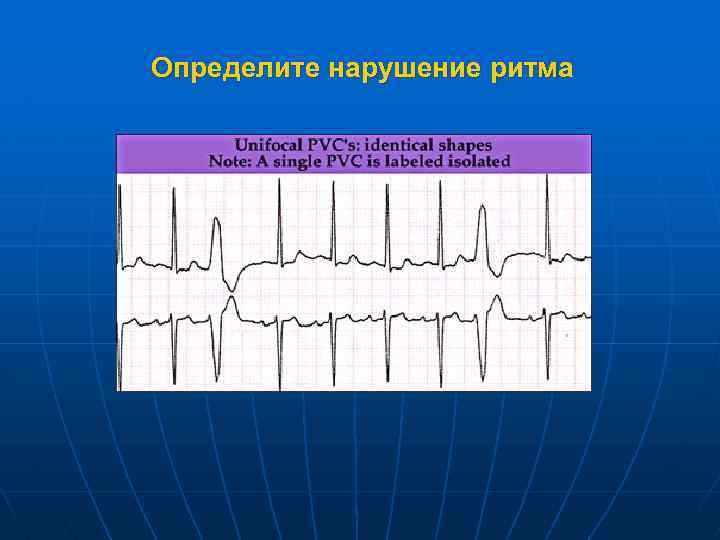 Определите нарушение ритма 