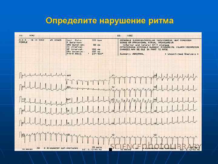 Определите нарушение ритма 