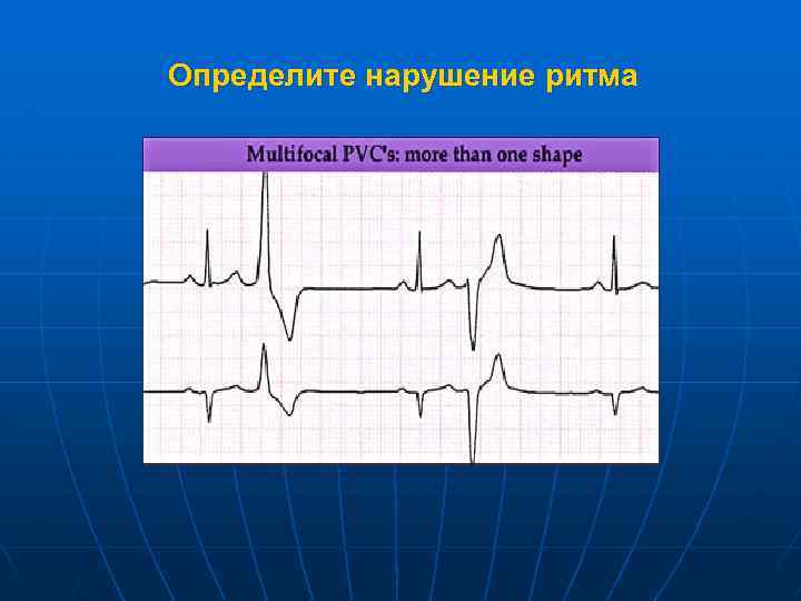 Определите нарушение ритма 