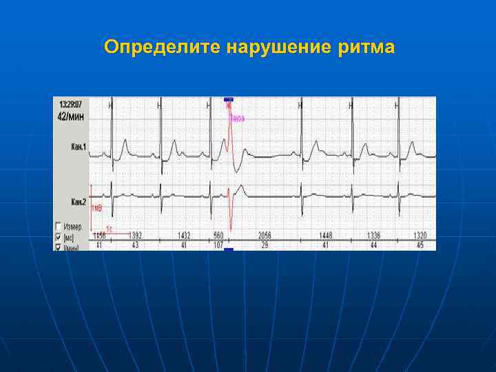 Определите нарушение ритма 
