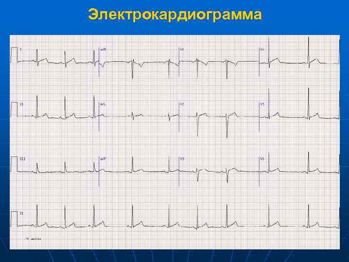 Электрокардиограмма 