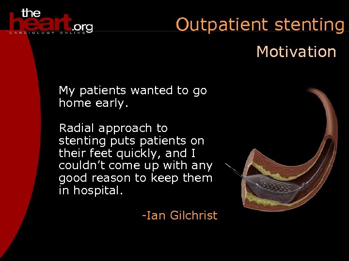 Outpatient stenting Motivation My patients wanted to go home early. Radial approach to stenting