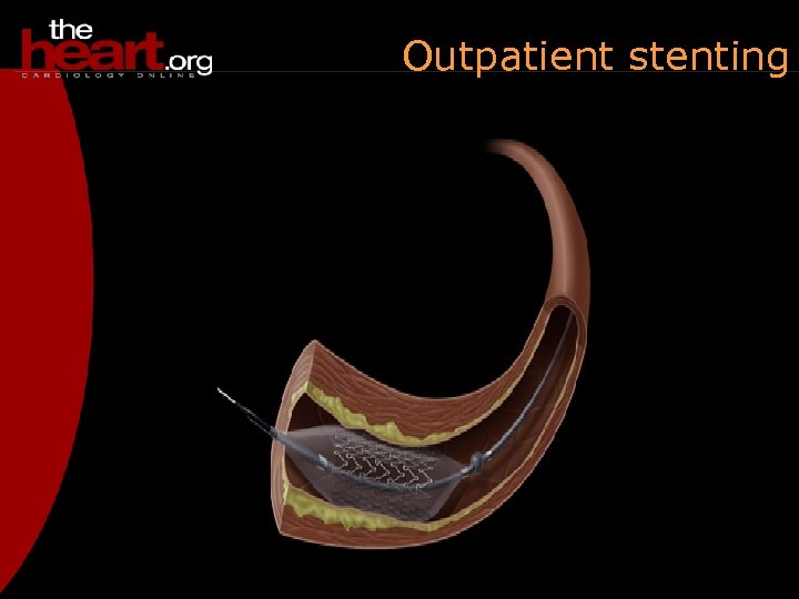 Outpatient stenting 