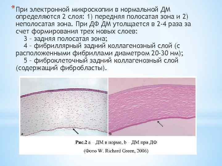 *При электронной микроскопии в нормальной ДМ определяются 2 слоя: 1) передняя полосатая зона и