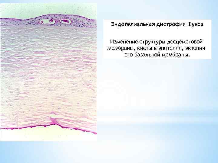 Эндотелиальная дистрофия Фукса Изменение структуры десцеметовой мембраны, кисты в эпителии, эктопия его базальной мембраны.