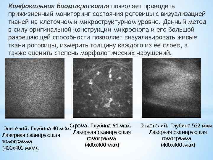 Конфокальная биомикроскопия позволяет проводить прижизненный мониторинг состояния роговицы с визуализацией тканей на клеточном и