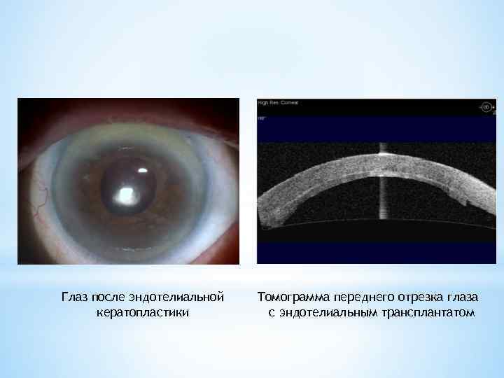 Глаз после эндотелиальной кератопластики Томограмма переднего отрезка глаза с эндотелиальным трансплантатом 
