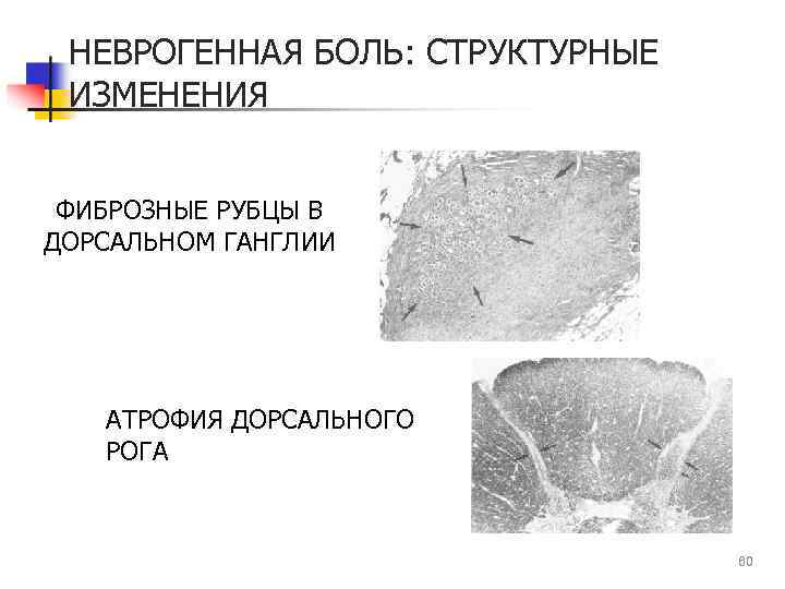 НЕВРОГЕННАЯ БОЛЬ: СТРУКТУРНЫЕ ИЗМЕНЕНИЯ ФИБРОЗНЫЕ РУБЦЫ В ДОРСАЛЬНОМ ГАНГЛИИ АТРОФИЯ ДОРСАЛЬНОГО РОГА 60 