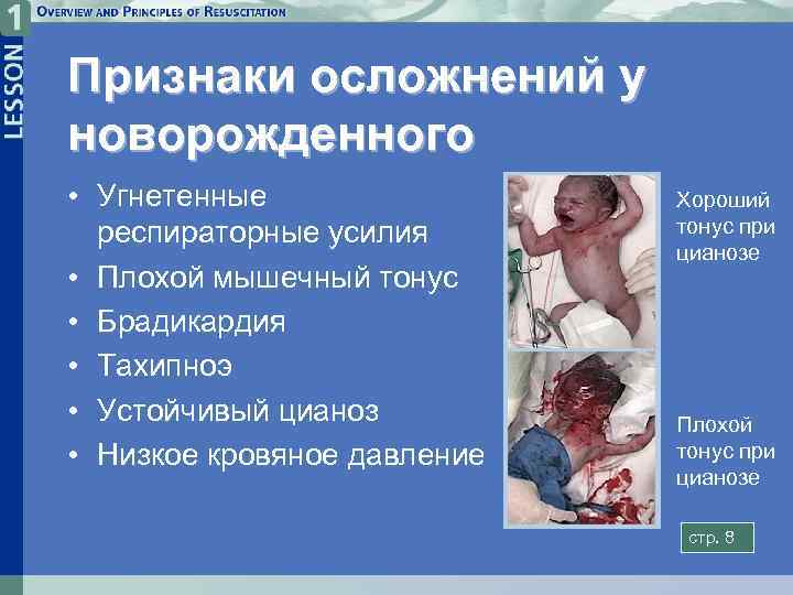 Признаки осложнений у новорожденного • Угнетенные респираторные усилия • Плохой мышечный тонус • Брадикардия