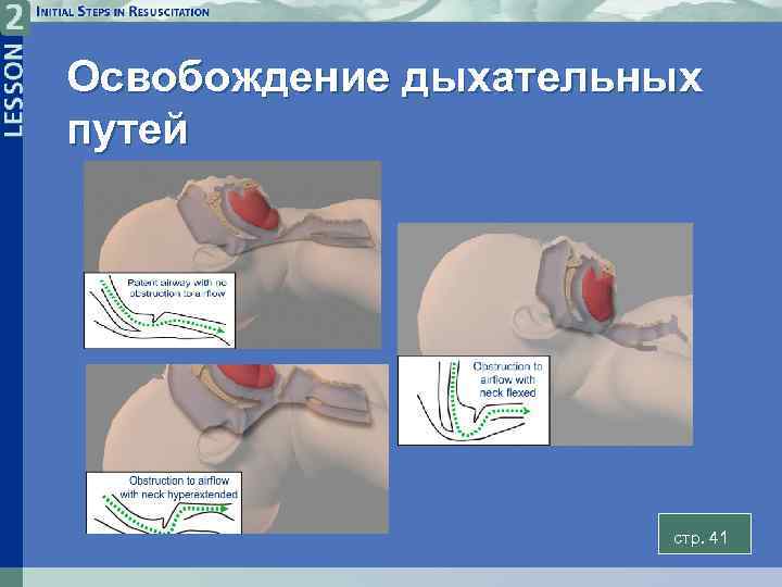 Освобождение дыхательных путей стp. 41 