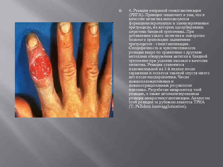  4. Реакция непрямой гемагглютинации (РИГА). Принцип заключает в том, что в качестве антигена