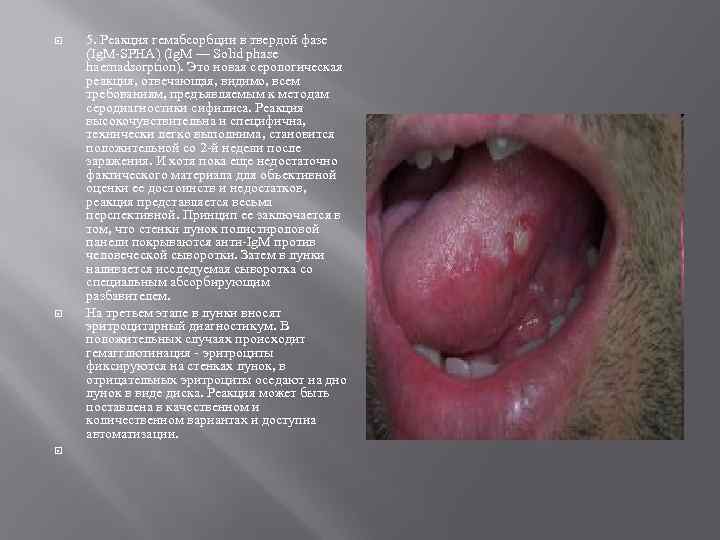  5. Реакция гемабсорбции в твердой фазе (Ig. M-SPHA) (Ig. M — Solid phase
