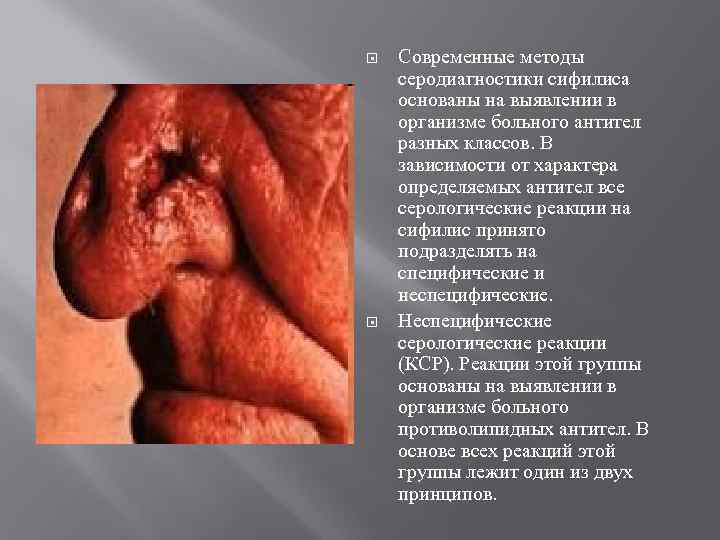  Современные методы серодиагностики сифилиса основаны на выявлении в организме больного антител разных классов.