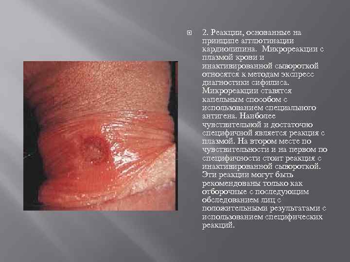  2. Реакции, основанные на принципе агглютинации кардиолипина. Микрореакции с плазмой крови и инактивированной