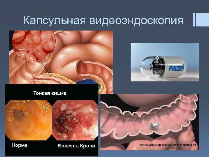Капсульная видеоэндоскопия 