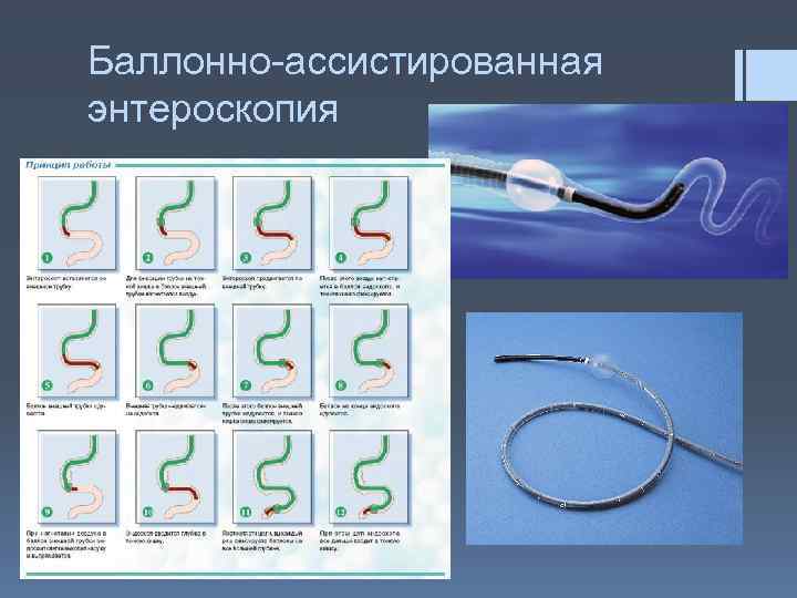 Баллонно-ассистированная энтероскопия 