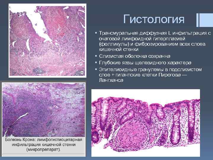 Гистология § Трансмуральная диффузная L инфильтрация с очаговой лимфоидной гиперплазией (фолликулы) и фиброзированием всех