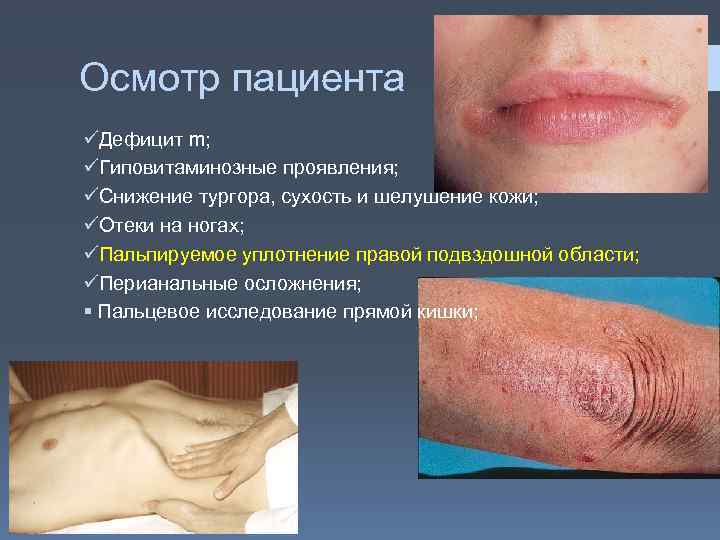 Осмотр пациента üДефицит m; üГиповитаминозные проявления; üСнижение тургора, сухость и шелушение кожи; üОтеки на