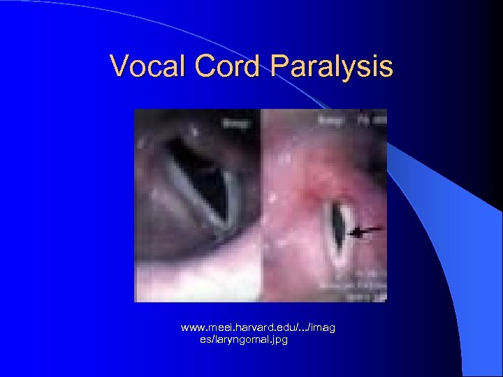 Vocal Cord Paralysis www. meei. harvard. edu/. . . /imag es/laryngomal. jpg 