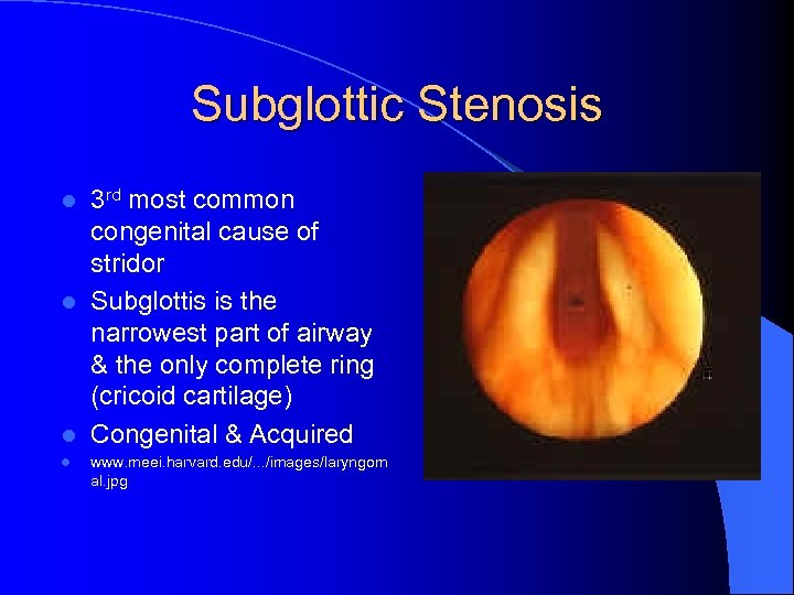 Subglottic Stenosis 3 rd most common congenital cause of stridor l Subglottis is the