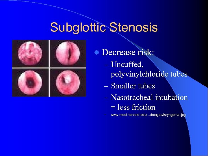 Subglottic Stenosis l Decrease risk: – Uncuffed, polyvinylchloride tubes – Smaller tubes – Nasotracheal
