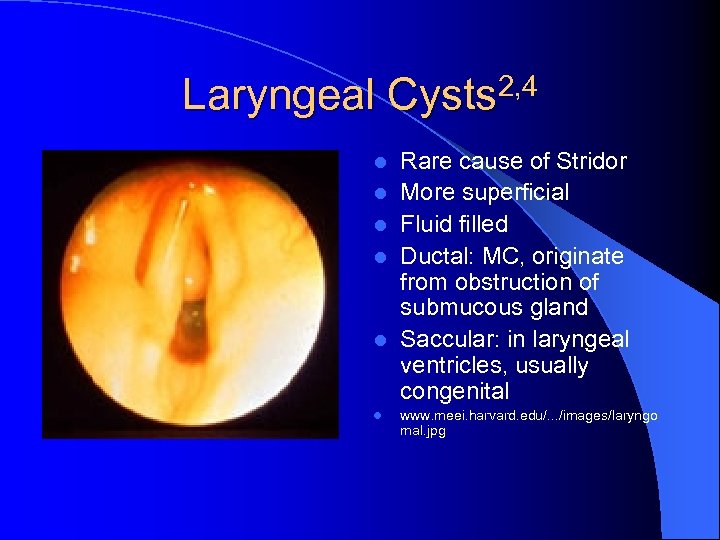 Laryngeal Cysts 2, 4 l l l Rare cause of Stridor More superficial Fluid