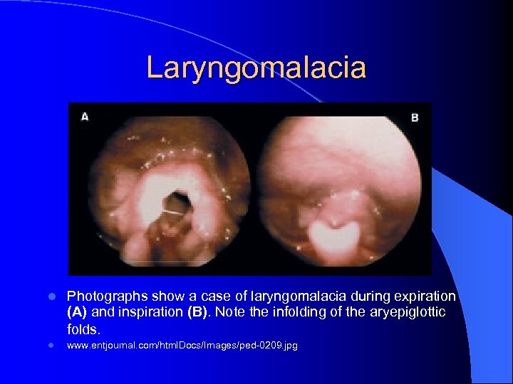 Laryngomalacia l Photographs show a case of laryngomalacia during expiration (A) and inspiration (B).
