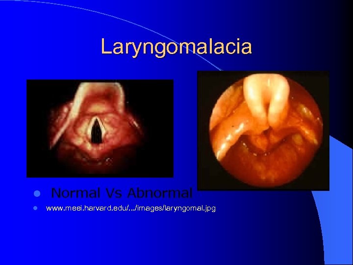 Laryngomalacia l l Normal Vs Abnormal www. meei. harvard. edu/. . . /images/laryngomal. jpg