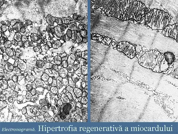 Electronogramă. Hipertrofia regenerativă a miocardului 