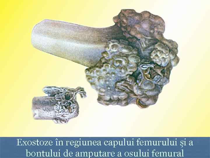 Exostoze în regiunea capului femurului şi a bontului de amputare a osului femural 