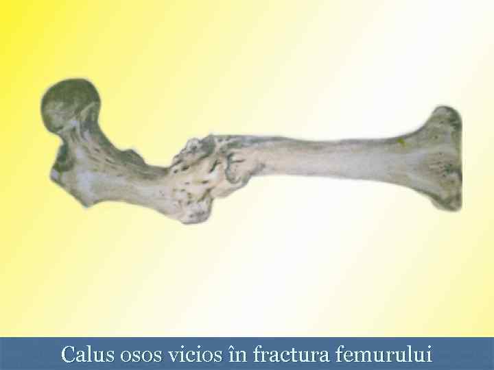 Calus osos vicios în fractura femurului 