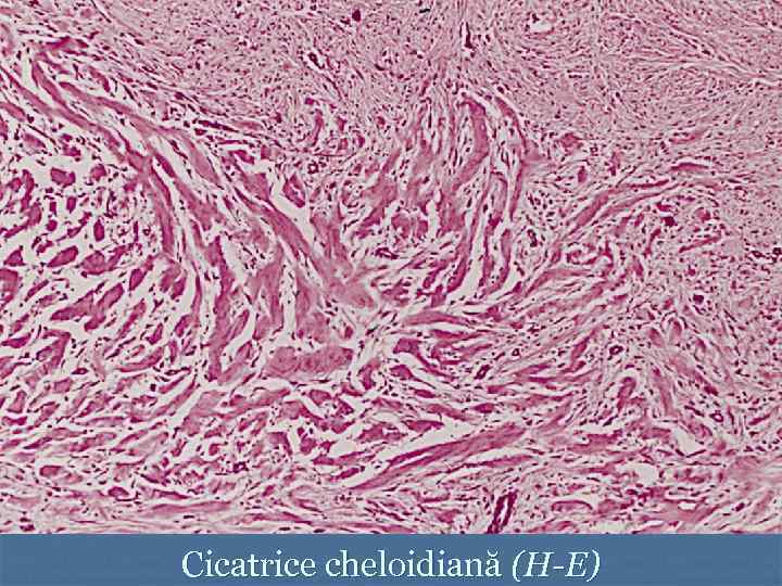 Cicatrice cheloidiană (H-E) 