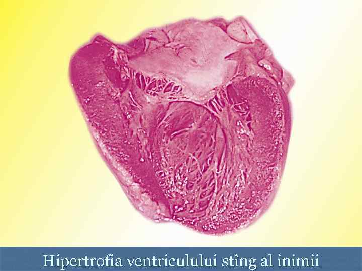 Hipertrofia ventriculului stîng al inimii 