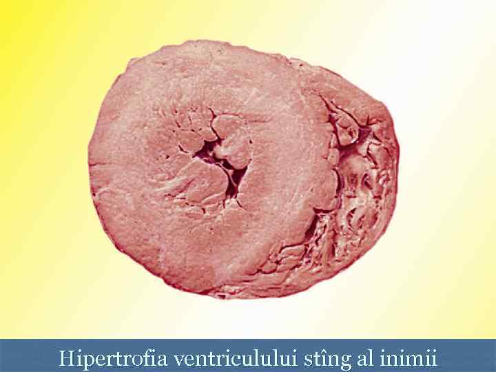 Hipertrofia ventriculului stîng al inimii 