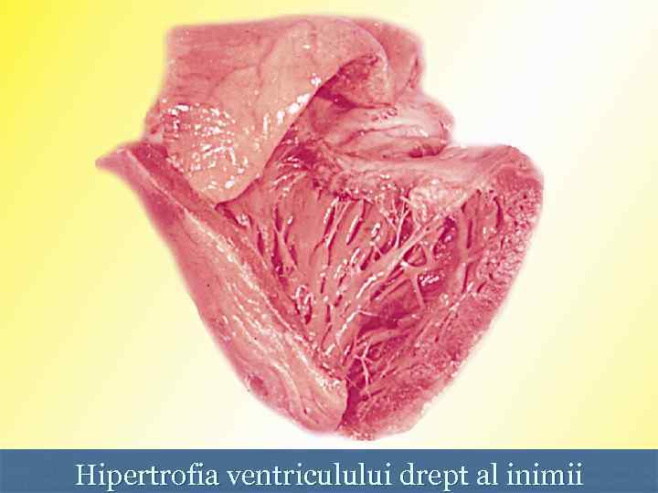 Hipertrofia ventriculului drept al inimii 