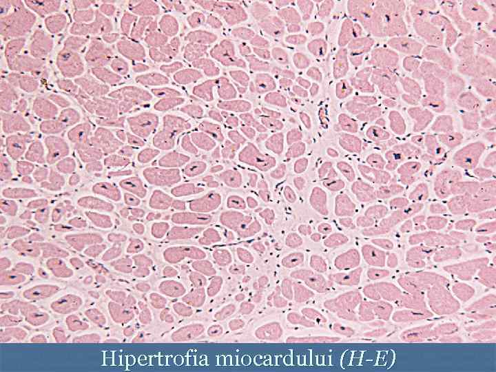 Hipertrofia miocardului (H-E) 