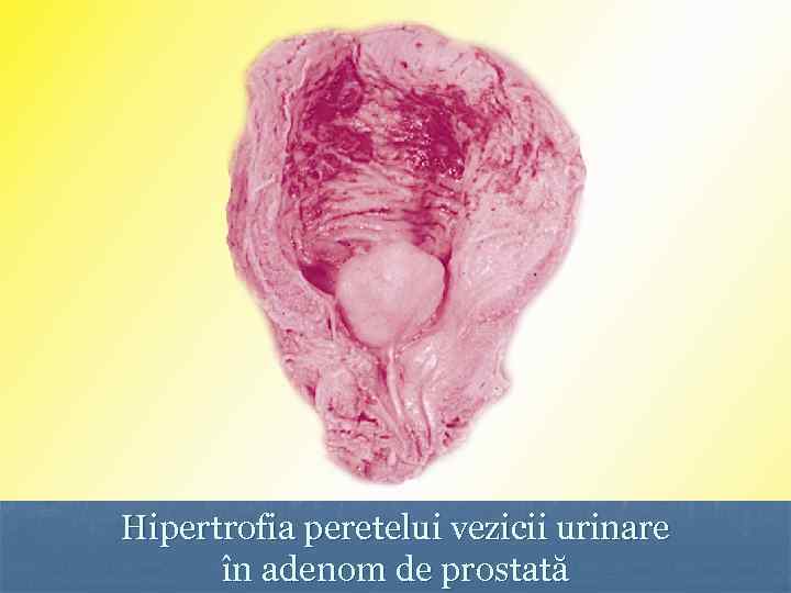 Hipertrofia peretelui vezicii urinare în adenom de prostată 