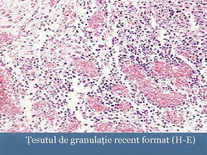 Ţesutul de granulaţie recent format (H-E) 