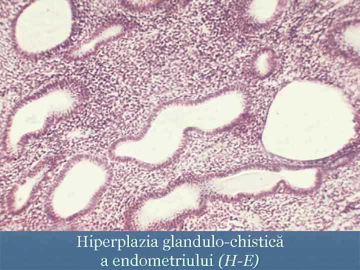 Hiperplazia glandulo-chistică a endometriului (H-E) 