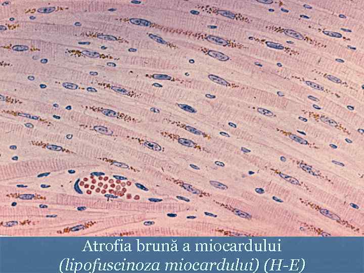 Atrofia brună a miocardului (lipofuscinoza miocardului) (H-E) 