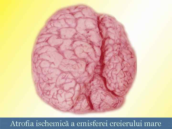 Atrofia ischemică a emisferei creierului mare 